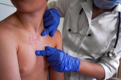 sarampión