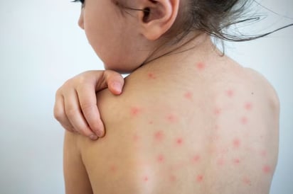 sarampión sarampión