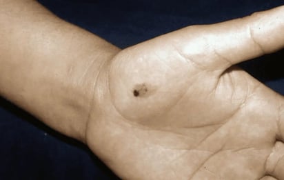 Esas manchas negras en tus manos podrían ser cáncer de piel: ¿Qué sabemos del melanoma acral?