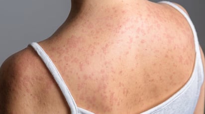 Sinaloa reporta su primer fallecimiento por sarampión