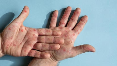 Cuáles son los síntomas de la variante más contagiosa de la “viruela del mono”