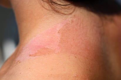 Señales de alerta: Cuándo una quemadura de sol requiere atención