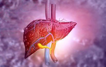 El consumo excesivo de alcohol mensual triplica el riesgo de enfermedad hepática