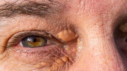 Colesterol en la mirada: 3 señales en tus ojos que revelan arterias obstruidas hoy