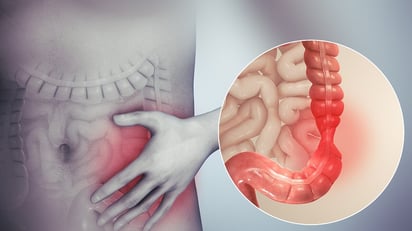 Síndrome del intestino irritable: qué sucede en el organismo durante una crisis y cuánto puede durar