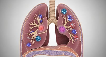 Descubren el origen de un cáncer de pulmón difícil de tratar
