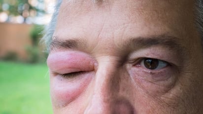 El tratamiento que podría cambiar el angioedema hereditario en México