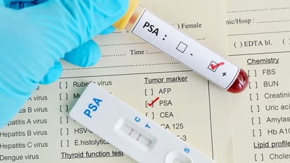 ENFERMEDADES  Un análisis de sangre utilizado para detectar el cáncer de próstata podría contribuir a disminuir el riesgo de muerte por esta enfermedad, de acuerdo