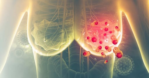 BioNTech y la biotecnológica OncoC4 dieron a conocer nuevos resultados clínicos sobre un tratamiento experimental para el cáncer de pulmón que podría