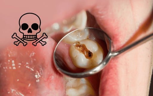 Pocas personas consideran que una caries aparentemente sencilla o una infección dental mal tratada pueda desencadenar consecuencias graves para la salud. 