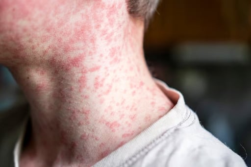 A un año del brote iniciado en Texas, autoridades internacionales analizan si Estados Unidos perdió la eliminación del sarampión ante contagios sostenidos