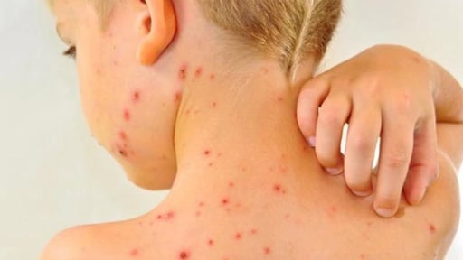 El brote de sarampión que se registra en México desde febrero del año pasado ha afectado principalmente a niñas y niños de entre uno y cuatro años de edad.
