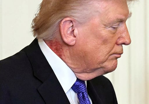 El estado de salud del presidente de Estados Unidos, Donald Trump, vuelve a generar inquietud. Ya no se trata únicamente de los hematomas visibles