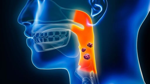 En los últimos 20 años, la mortalidad por cáncer oral y cáncer orofaríngeo en Latinoamérica y el Caribe ha mostrado un comportamiento desigual, marcado