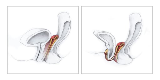 El uso de rodilleras deportivas se ha vuelto cada vez más común en gimnasios, parques y canchas.  Existen desde modelos elásticos hasta otros con soportes