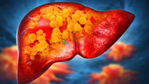 La esteatosis hepática metabólica, conocida popularmente como “hígado graso”, es una afección en la que se acumula grasa en el hígado debido a alteraciones