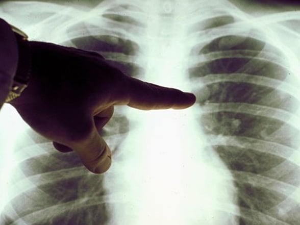 ENFERMEDADES El cáncer de pulmón continúa siendo la principal causa de muerte por cáncer en Estados Unidos, representando cerca de una de cada cuatro muertes por esta