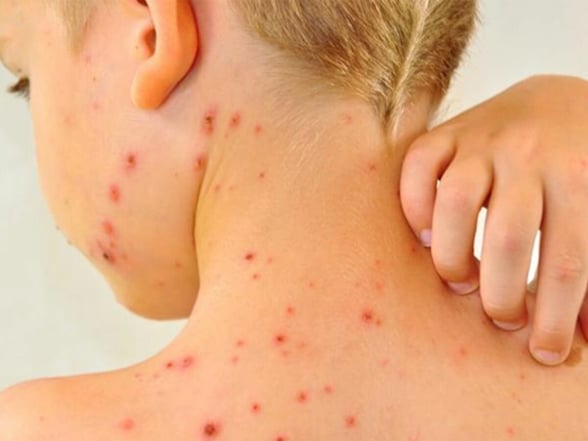 SARAMPIÓN       Autoridades de salud mantienen activa la vigilancia epidemiológica en la región norte de Coahuila ante los recientes brotes de sarampión registrados