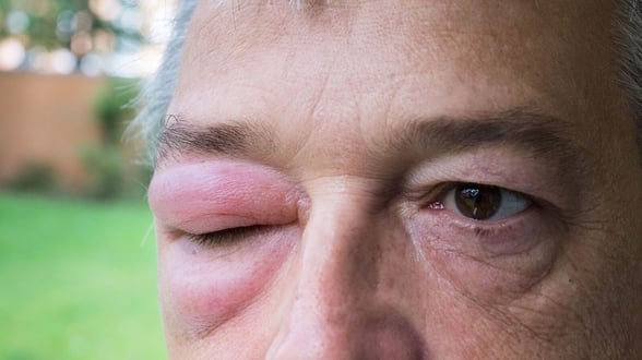 ENFERMEDADES  El angioedema hereditario (AEH) es una enfermedad rara que provoca episodios de inflamación repentina y dolorosa en distintas partes del cuerpo, como la piel,