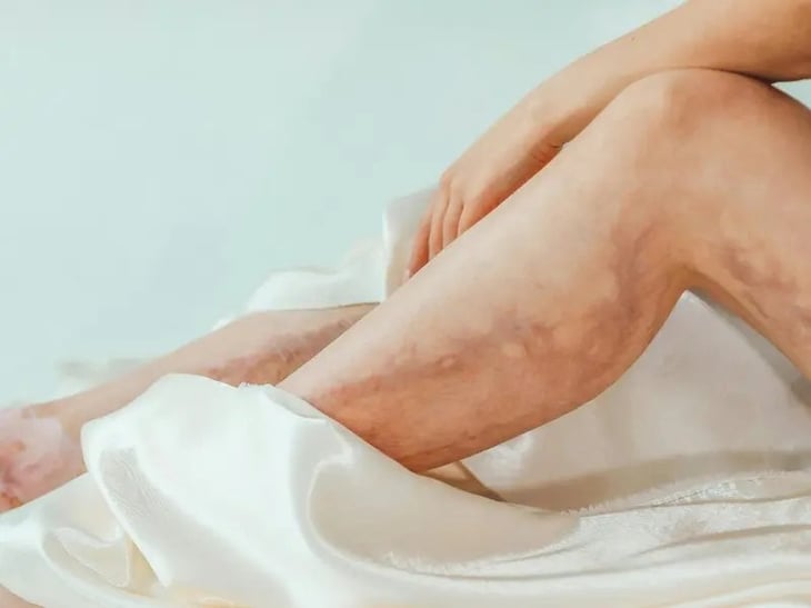 ¡Cuida tus piernas! Consejos clave para prevenir que las varices empeoren