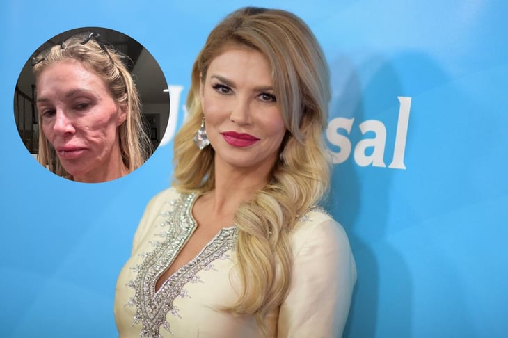 'Mi rostro se está derritiendo': El desesperado grito de auxilio de Brandi Glanville