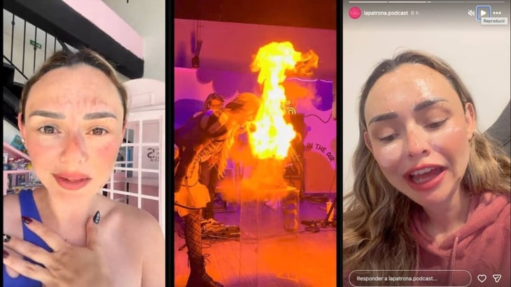 Así quedó el rostro de Arlen Hernández tras su accidente con pastel flamable