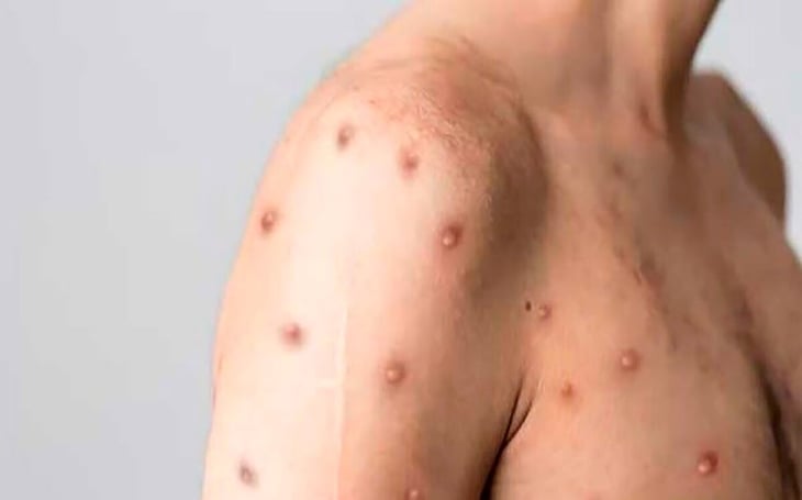 Alerta sanitaria: paciente alemán trae viruela símica a México