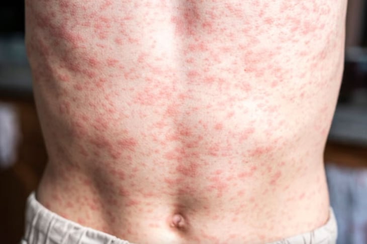 México registra 9,074 casos de sarampión