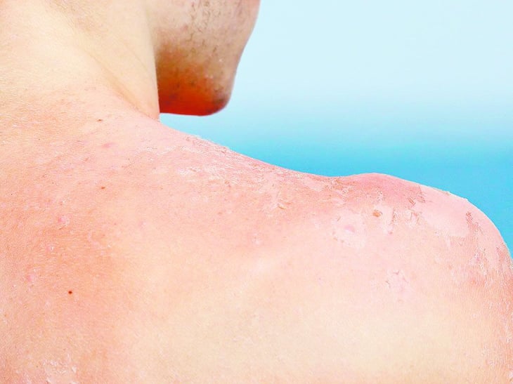 Coahuila refuerza prevención por cáncer de piel por rayos UV