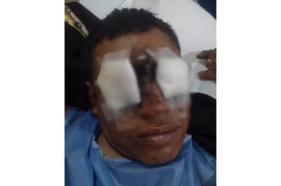 Médicos salvan la vista de Miguel Palacio tras accidente con pirotecnia
