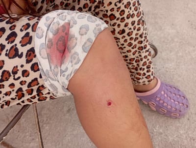 Niña herida por mordedura de perro en Ciudad Deportiva