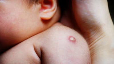 Región sin vacunas BCG para recién nacidos: riesgo de tuberculosis 