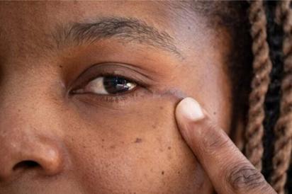 Cirujanos hacen historia al extirpar un tumor cerebral a través del ojo de una mujer