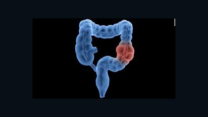 Cáncer colorrectal: diferencias entre adultos jóvenes y mayores