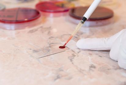 Un análisis de sangre detecta con precisión el cáncer de colon