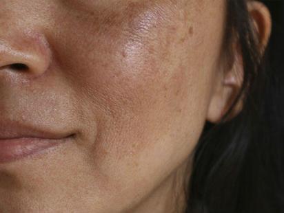 Paño o melasma: Todo lo que necesitas saber sobre esta condición de la piel