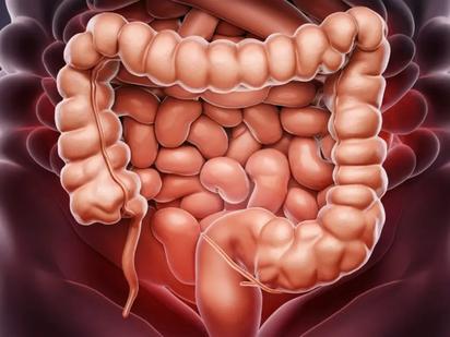 Cáncer de colon: etapas y qué tan mortal es