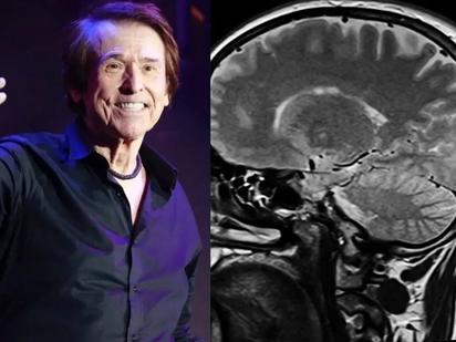 Qué es un linfoma cerebral: tipos, síntomas y todo lo que debes saber