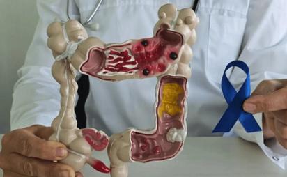 El alimento que podría ser clave para prevenir el cáncer de colon, según un estudio de Harvard