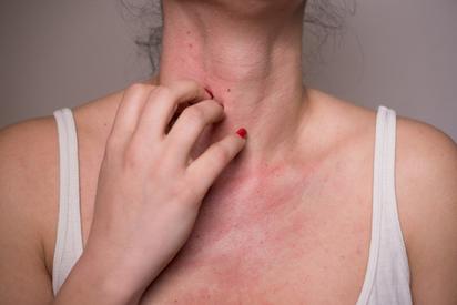 ¿Eres alérgico al sol? Descubre cómo identificar y tratar esta condición