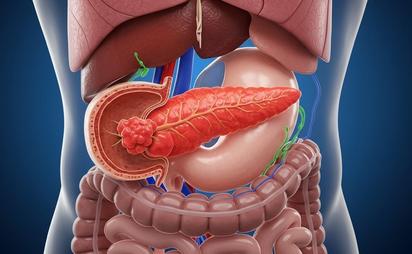Cáncer de páncreas: descubren círculos secretos de ADN que impulsan su agresividad