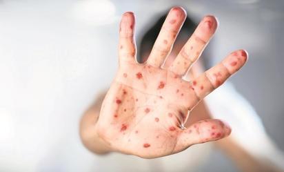 Ssa alerta por sarampión en EE.UU. y Canadá; recomienda vacunación