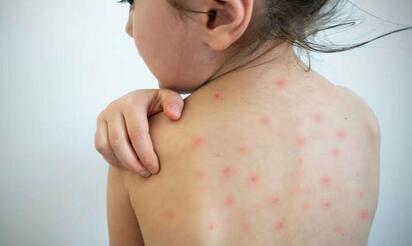 Descartan nuevos casos de sarampión en Piedras Negras; no hay sospechosos en seguimiento