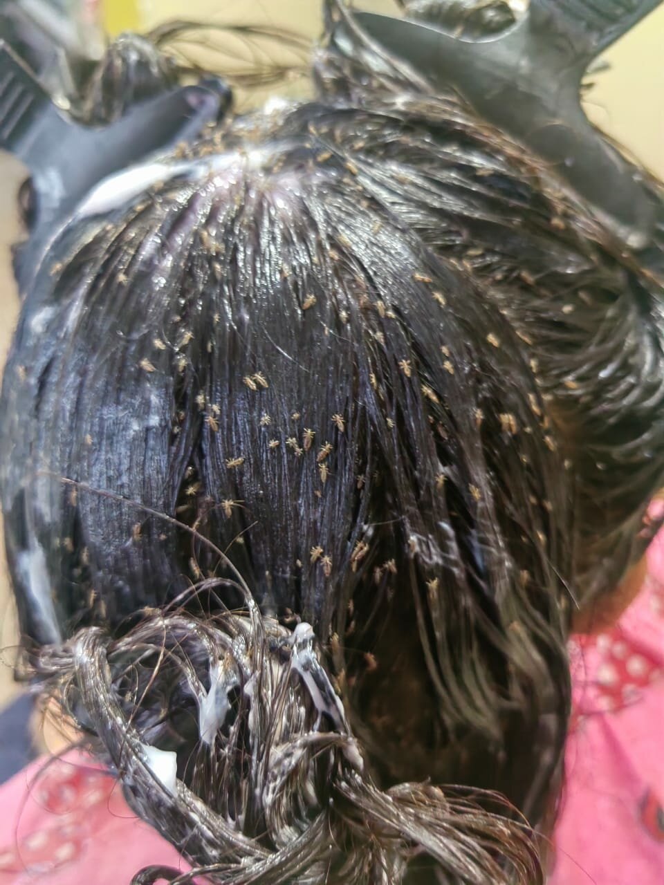 Pediculosis