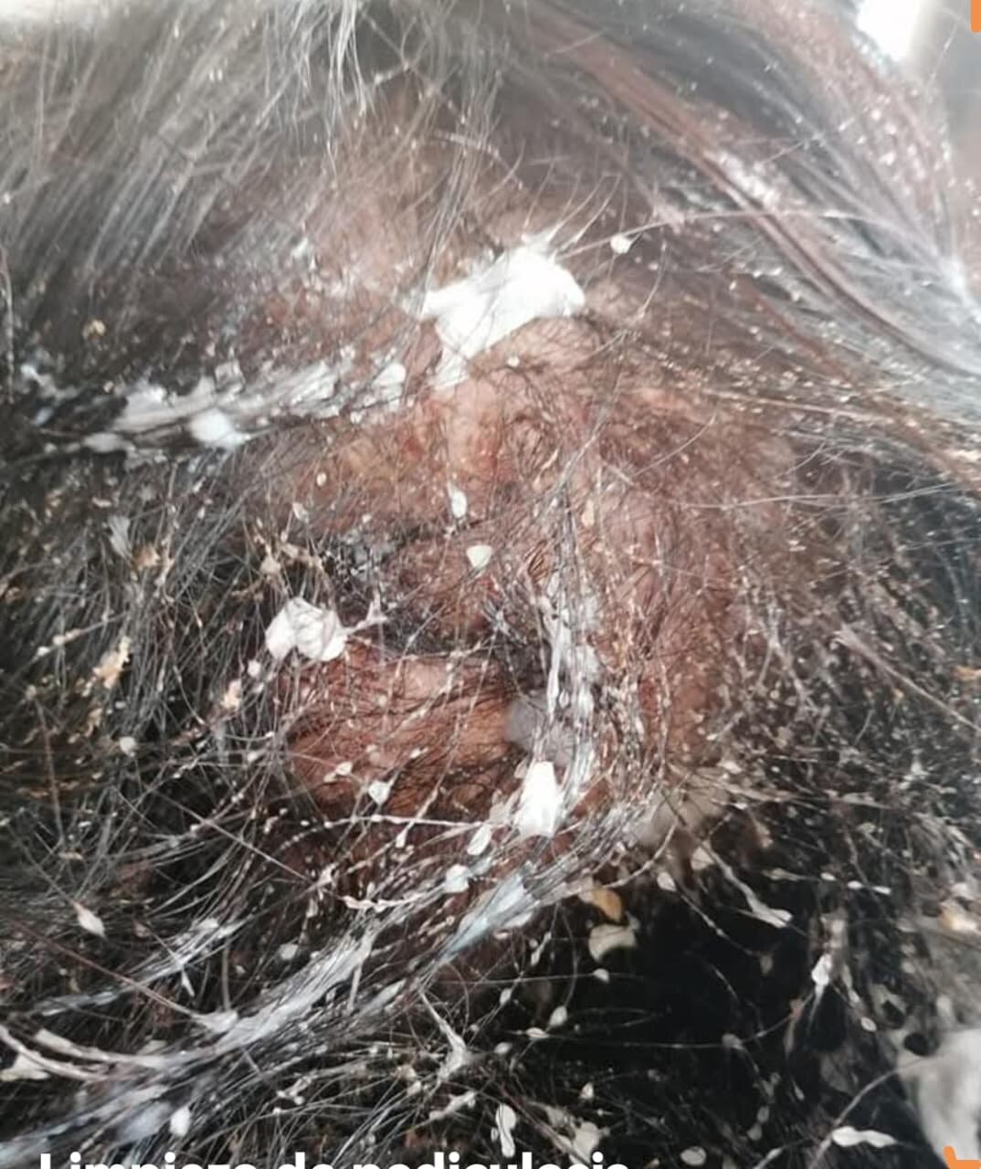 Pediculosis
