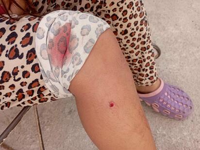 Niña herida por mordedura de perro en Ciudad Deportiva
