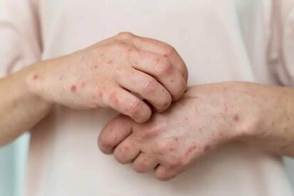 Suman 21 casos de sarampión en Durango en lo que va del año