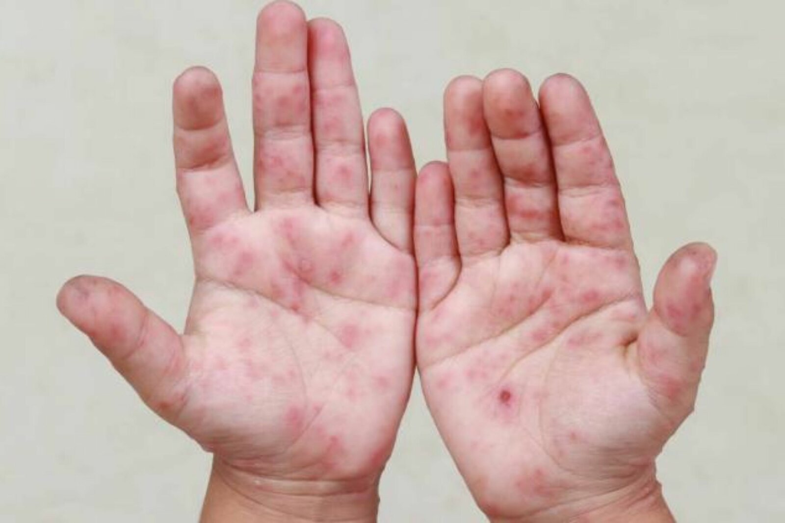 Autoridades investigan posible brote de virus coxsackie en colegio de Saltillo