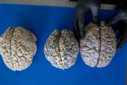 Identifican seis metabolitos clave para detectar la demencia