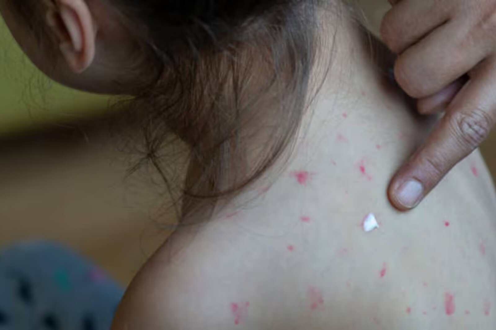 Sarampión en México aumenta 137% en 2026; suman 8 mil 901 casos